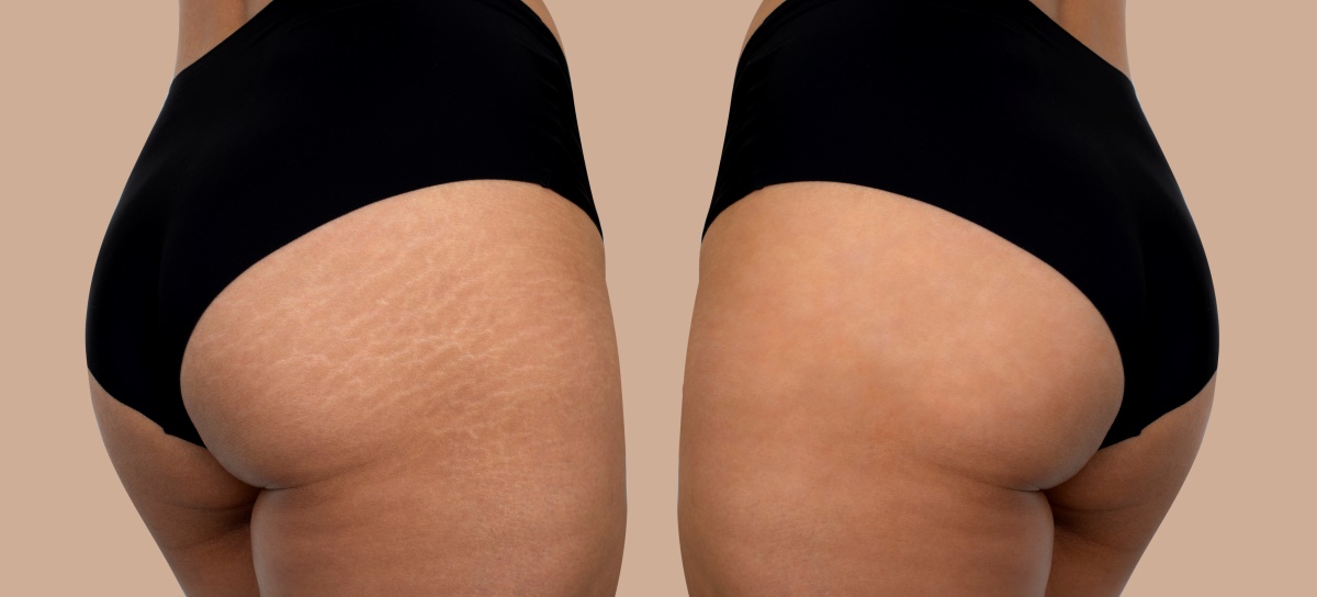 Stretch Marks Before and After